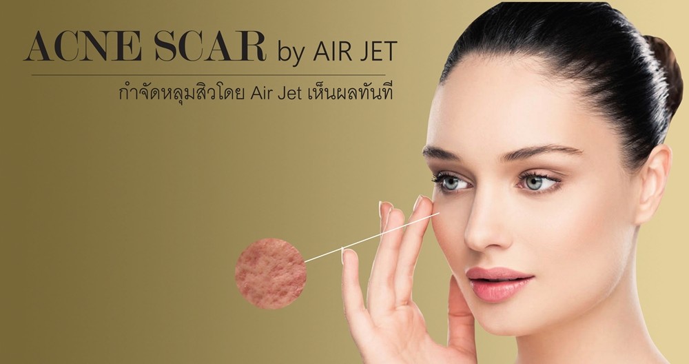 เติมเต็มหลุมสิว ด้วย AIR JET